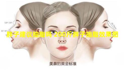 胖子建议抽脂吗 200斤胖子抽脂效果图